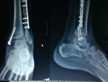 AP and lateral radiographs of the ankle demonstrating a Weber B bimalleolar ankle fracture. The fibular fracture is at the level of the syndesmosis (trans-syndesmotic). There is an associated transverse medial malleolar fracture. The mortise view shows lateral talar shift with increased medial clear space (>4mm) indicating deltoid ligament injury or medial malleolar fracture. The posterior malleolus is intact on lateral view.