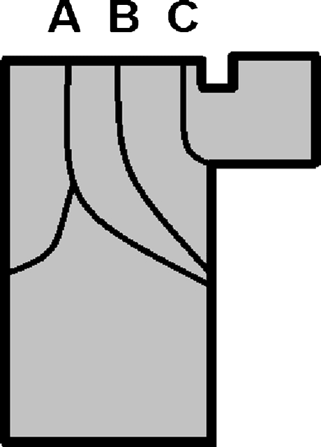 Coronal CT scan through the posterior facet of the calcaneus demonstrating a Sanders Type III intra-articular calcaneal fracture. Three fracture lines divide the posterior facet into four fragments. The lateral wall is displaced and blown out. Böhler's angle is flattened on the lateral radiograph (inset). This is a high-energy injury requiring surgical management with attention to soft tissue handling.