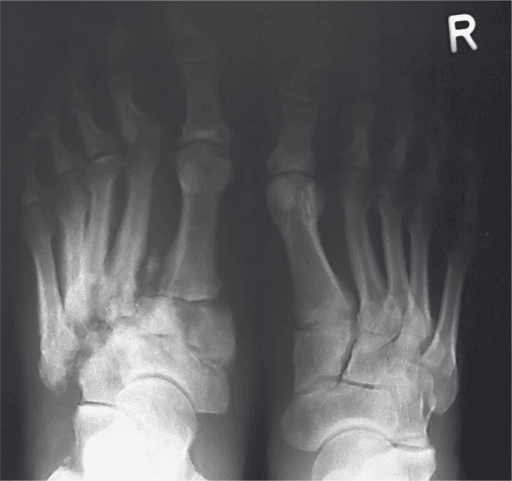 Clinical image for Charcot Neuroarthropathy