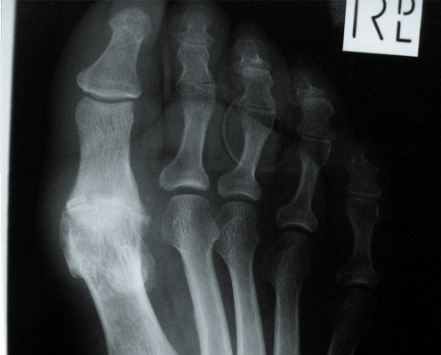 Clinical image for Hallux Rigidus