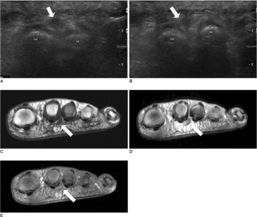 Clinical image for Morton's Neuroma