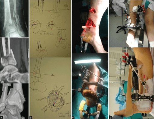 Coronal and sagittal CT reconstructions demonstrating a comminuted pilon fracture. The articular surface of the distal tibia is split into multiple fragments with central impaction (die-punch fragment). There is metaphyseal comminution and an associated fibular fracture. The talus has driven upward creating the 'explosion' injury pattern. This high-energy injury requires staged management.