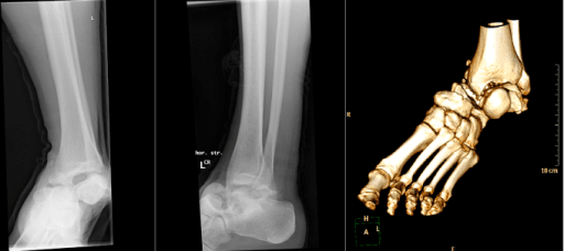 AP and lateral radiographs demonstrating a Hawkins Type II talar neck fracture. The lateral view shows the displaced fracture through the talar neck with subtalar joint subluxation (body displaced posteriorly). On the AP view, the ankle mortise appears intact but there is incongruity of the subtalar joint. This fracture pattern is at high risk of avascular necrosis (40-50%).