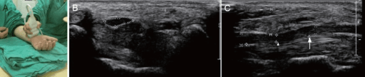 Cross-sectional anatomy of the carpal tunnel at the level of the hook of hamate. The median nerve lies superficially, just deep to the transverse carpal ligament (flexor retinaculum). The nine flexor tendons (4 FDP, 4 FDS, FPL) fill the tunnel. The median nerve is flattened and enlarged proximally. The thenar branch exits radially. Release involves dividing the transverse carpal ligament while protecting the nerve and palmar cutaneous branch.
