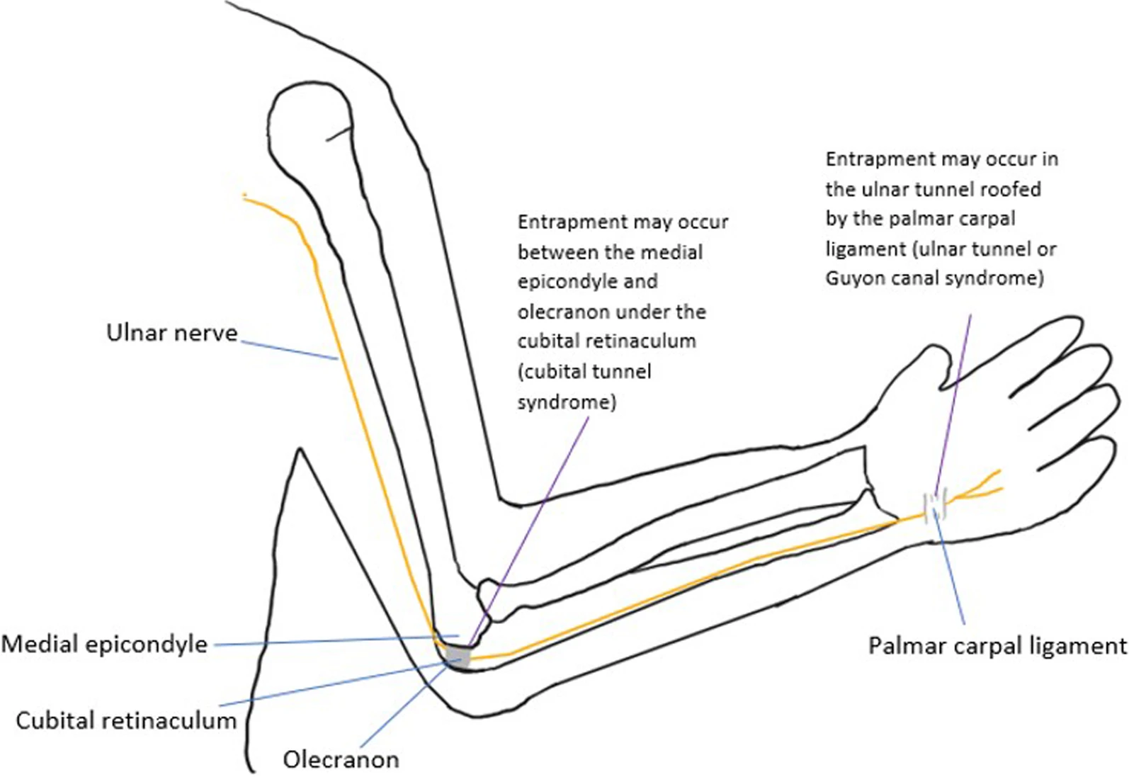 Clinical photograph demonstrating ulnar nerve palsy with intrinsic wasting (first dorsal interosseous, hypothenar) and claw deformity of ring and small fingers (MCP hyperextension, IP flexion). The anatomical diagram shows the course of the ulnar nerve through the cubital tunnel, bounded by the medial epicondyle, olecranon, and Osborne's ligament. FCU muscle belly forms the distal tunnel boundary.