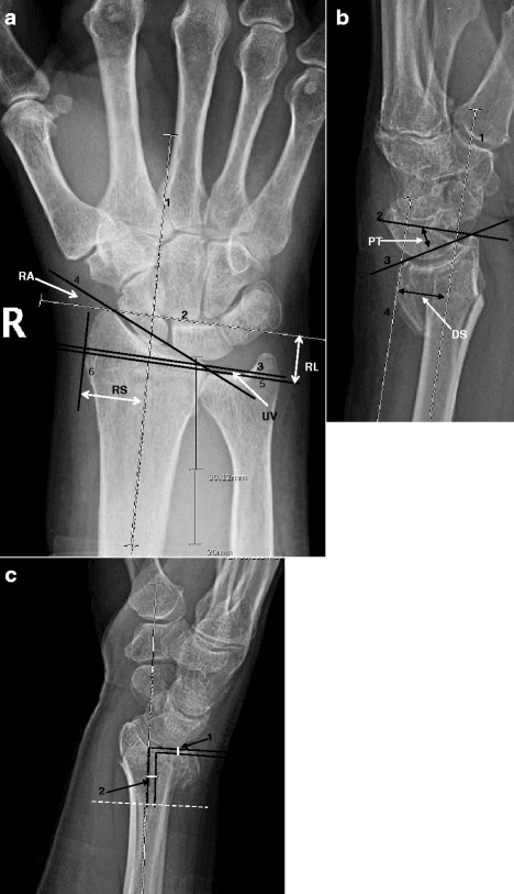 PA and lateral wrist radiographs of a 58-year-old female showing a dorsally displaced distal radius fracture. Key measurements: dorsal tilt 25° (normal 11° volar), radial inclination 12° (normal 22°), radial height 8mm (normal 12mm), positive ulnar variance. Intra-articular step-off of 2mm is visible. This represents an unstable fracture pattern requiring surgical fixation.