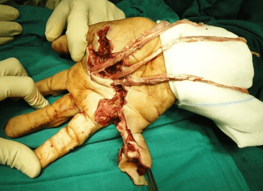 Clinical photograph demonstrating examination of flexor tendon function. The ring finger is held in extension at rest (cascade disrupted). Testing FDP: holding middle phalanx, patient cannot flex DIP. Testing FDS: holding adjacent fingers extended, patient cannot flex PIP. This demonstrates complete laceration of both FDP and FDS tendons in Zone II (no man's land). Urgent surgical repair is required.