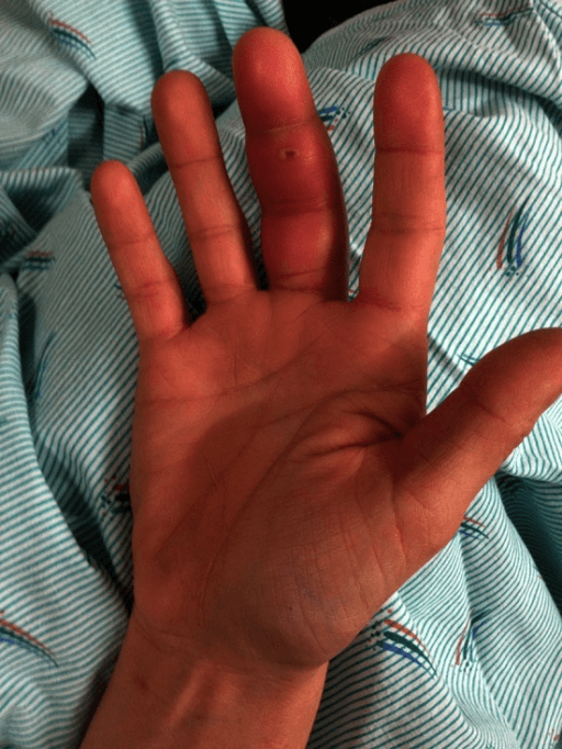 Clinical photographs demonstrating infectious flexor tenosynovitis of the middle finger. All four Kanavel signs are present: (1) fusiform swelling of the finger, (2) finger held in flexion, (3) tenderness along the flexor sheath, and (4) pain on passive extension. This represents a surgical emergency requiring urgent sheath irrigation to prevent tendon necrosis and loss of finger function.