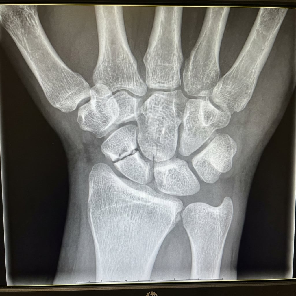 PA wrist radiograph with scaphoid (ulnar deviation) view demonstrating a displaced scaphoid waist fracture. There is >1mm displacement and >15° humpback deformity. The fracture line is clearly visible across the waist. No secondary arthritis is present. This fracture pattern has increased non-union risk and requires surgical fixation with headless compression screw.
