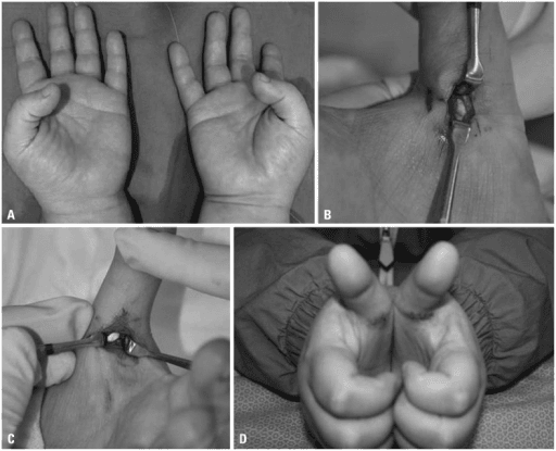 Clinical photograph of the right ring finger demonstrating locked trigger finger - the finger is flexed at the PIP and cannot actively extend. Passive extension is possible with a palpable click. The anatomical diagram shows the A1 pulley location at the metacarpal head and its relationship to the flexor tendons. Thickening of the A1 pulley and tendon nodule formation cause the triggering phenomenon.