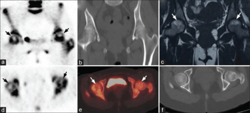 Clinical image for Avascular Necrosis of the Femoral Head
