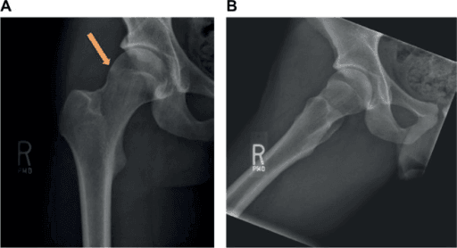 Clinical image for Femoroacetabular Impingement