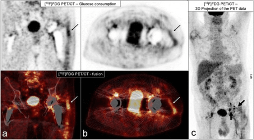 Clinical image for Periprosthetic Joint Infection