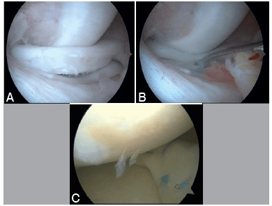 Clinical image for Meniscal Tears and Root Injuries