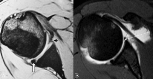Clinical image for Anterior Shoulder Instability