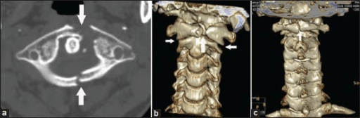 Axial and coronal CT images demonstrating a Jefferson burst fracture of C1 with bilateral anterior and posterior arch fractures. There is lateral displacement of the C1 lateral masses with a combined lateral mass displacement (LMD) of 8mm measured on open-mouth odontoid view. The transverse ligament status is concerning. This represents an unstable C1 ring fracture.