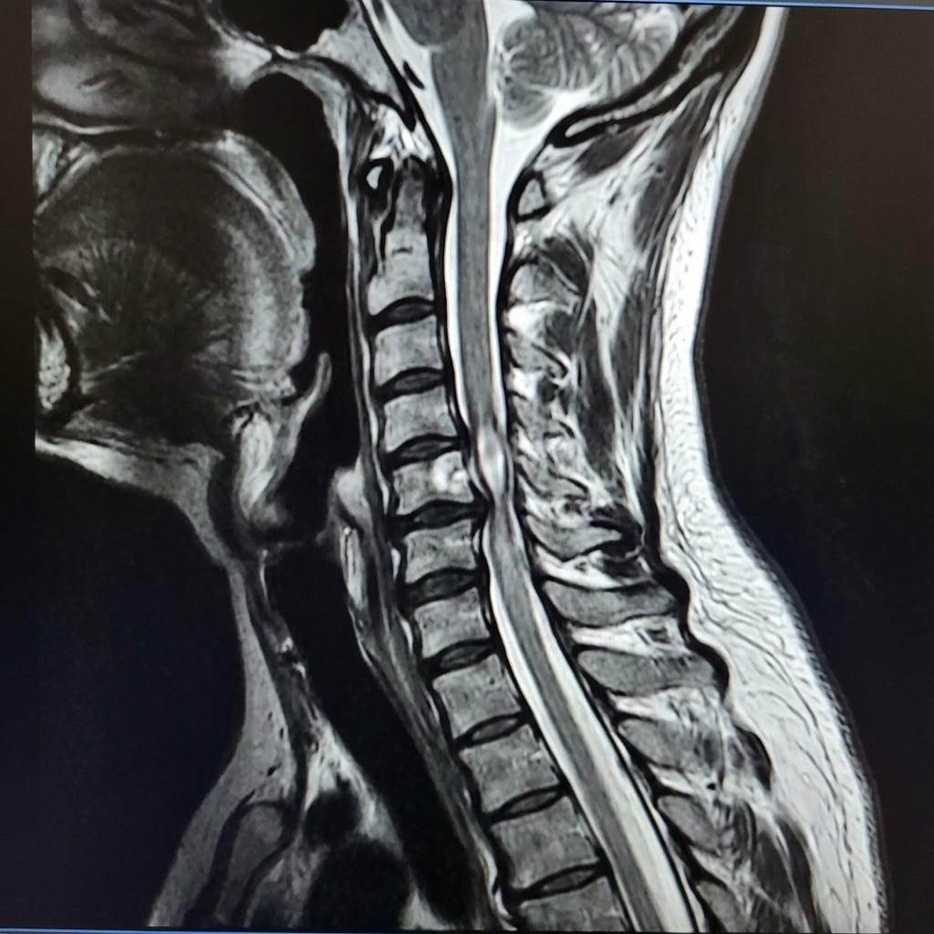 Sagittal T2-weighted MRI demonstrating multi-level cervical stenosis at C3-4, C4-5, and C5-6. There is cord compression with intramedullary T2 hyperintensity at C4-5 level indicating myelomalacia. The cord appears flattened and draped over disc-osteophyte complexes. Ligamentum flavum hypertrophy contributes posteriorly. This represents degenerative cervical myelopathy (DCM) requiring surgical decompression.