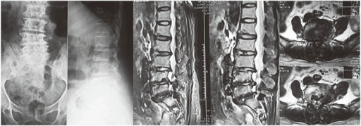 Axial and sagittal T2-weighted MRI demonstrating severe central canal stenosis at L4-5 with trefoil-shaped canal. There is bilateral ligamentum flavum hypertrophy, facet joint hypertrophy, and disc bulge causing circumferential compression of the cauda equina. Multiple levels show degenerative changes. This represents degenerative lumbar spinal stenosis causing neurogenic claudication.