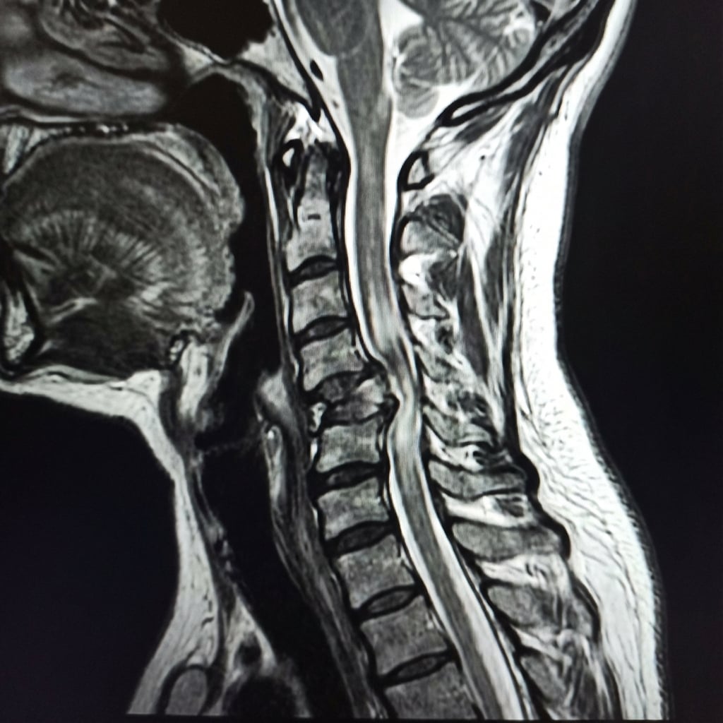 Sagittal T2-weighted MRI demonstrating C5-6 fracture-dislocation with anterior translation of C5 on C6. There is severe spinal cord compression with intramedullary T2 hyperintensity extending from C4 to C7 consistent with cord edema and contusion. The posterior ligamentous complex is disrupted. This represents complete spinal cord injury at C5 level.