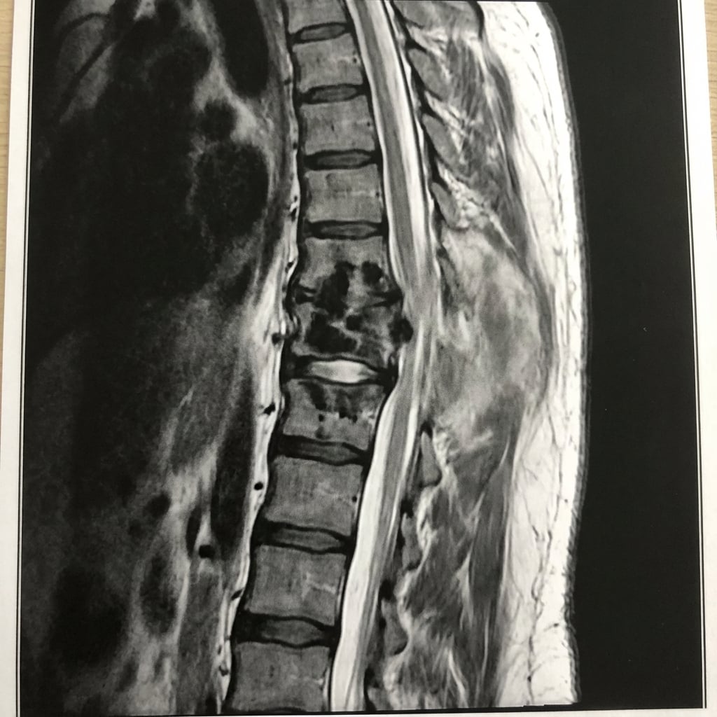 Sagittal and axial T2-weighted MRI demonstrating destruction of T10 and T11 vertebral bodies with relative preservation of the disc spaces (characteristic). Large paravertebral abscess extends anterolaterally. There is gibbus kyphotic deformity and spinal cord compression. This represents spinal tuberculosis (Pott's disease) requiring antitubercular chemotherapy and surgical consideration.