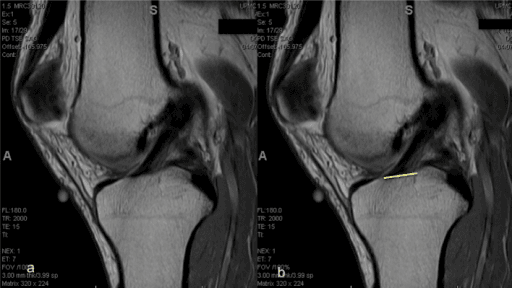 Clinical image for ACL Reconstruction and Graft Selection
