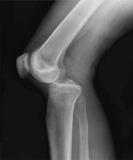 Clinical image for Multi-Ligament Knee Injury