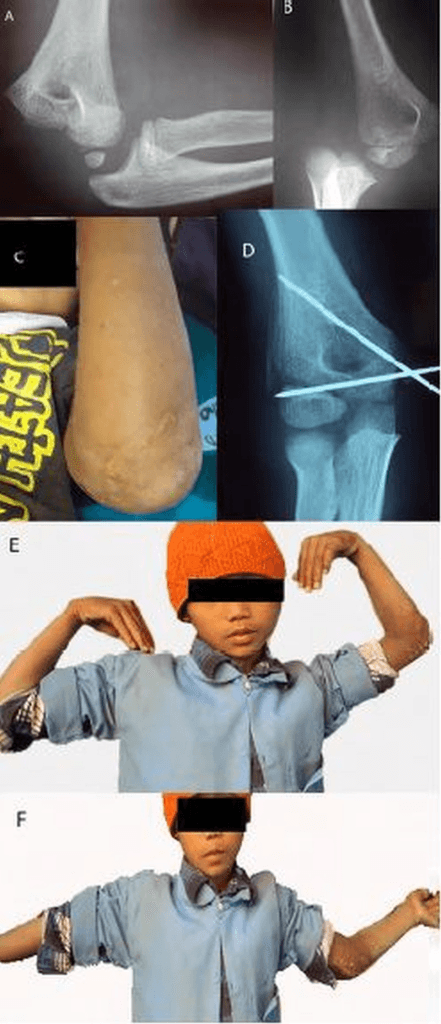 AP and lateral radiographs demonstrating chronic posterolateral elbow dislocation. There is heterotopic ossification around the joint, the coronoid is remodeled, and there is significant joint incongruity. The injury is 4 months old. The humeral trochlea shows early degenerative changes from chronic subluxation.