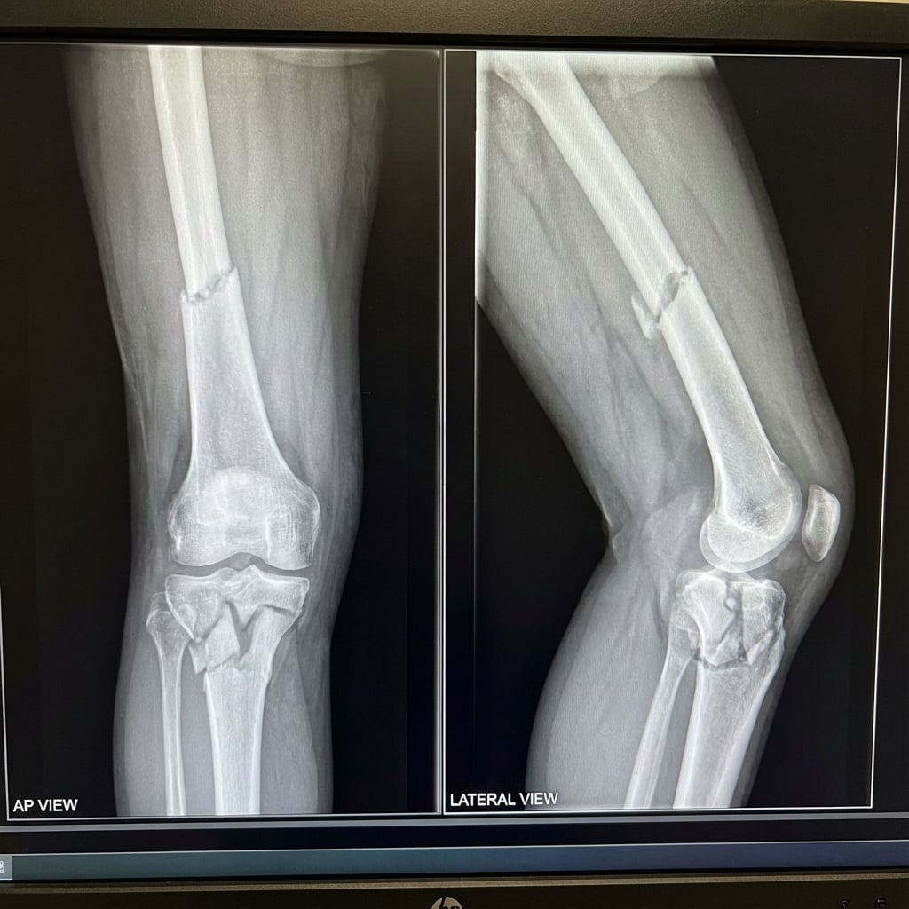 AP and lateral radiographs of the left leg showing ipsilateral displaced femoral shaft fracture (mid-diaphysis, transverse) and comminuted tibial plateau fracture. The knee is 'floating' without bony stability above or below.