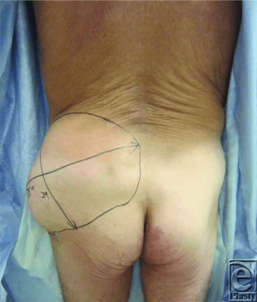 MRI T2-weighted image demonstrating large fluid collection between subcutaneous tissue and fascia over the lateral thigh. The collection shows heterogeneous signal indicating hemolymphatic contents. Clinical photograph shows fluctuant swelling with skin degloving pattern. This represents a significant soft tissue injury requiring careful management prior to any fracture surgery.