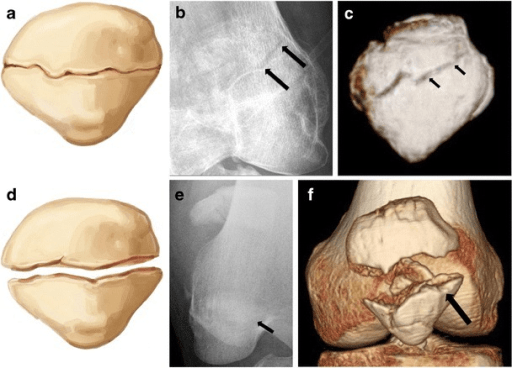 AP and lateral radiographs demonstrating displaced transverse patella fracture through the mid-portion with 5mm separation between fragments. The proximal pole is migrated superiorly due to quadriceps pull, indicating extensor mechanism disruption. Knee effusion is present.