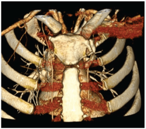 Axial CT scan demonstrating posterior displacement of the medial clavicle behind the sternum. The displaced clavicle is in close proximity to the trachea, esophagus, and great vessels. There is soft tissue swelling anteriorly. This represents a potentially life-threatening injury requiring reduction in a controlled setting with cardiothoracic backup.