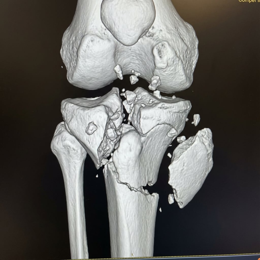 CT 3D reconstruction showing Schatzker VI bicondylar tibial plateau fracture with lateral plateau depression, medial split, and metaphyseal-diaphyseal dissociation. Note posteromedial fragment and articular comminution.