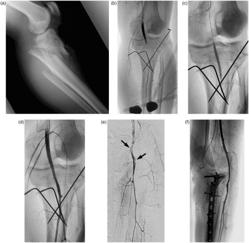 Post-reduction radiographs showing concentrically reduced knee joint. Clinical photograph demonstrates pale, cold foot with absent pulses indicating popliteal artery injury. The combination of knee dislocation and limb ischemia represents a limb-threatening emergency requiring immediate intervention.