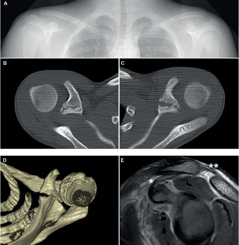 Clinical image for Acromioclavicular Joint Injury