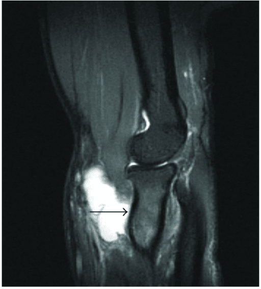 Clinical image for Distal Biceps Tendon Rupture