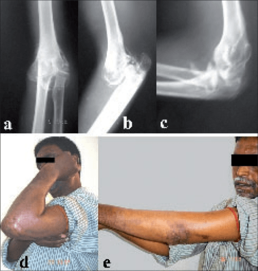 Clinical image for Post-Traumatic Elbow Stiffness