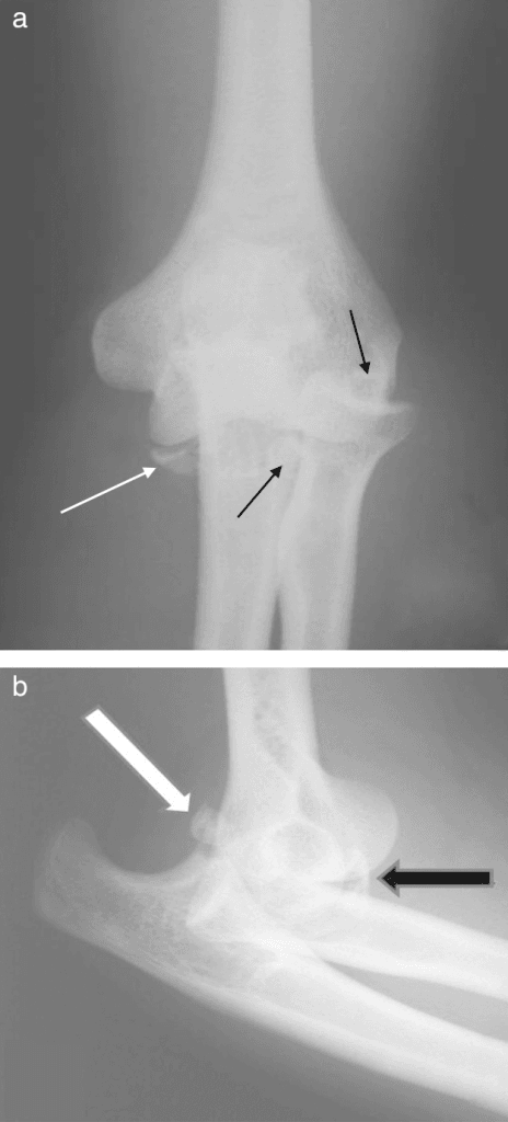 Clinical image for Terrible Triad of the Elbow