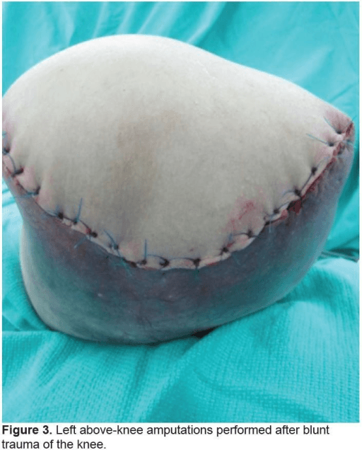 Left above-knee amputation stump with sutured flap closure after blunt knee trauma