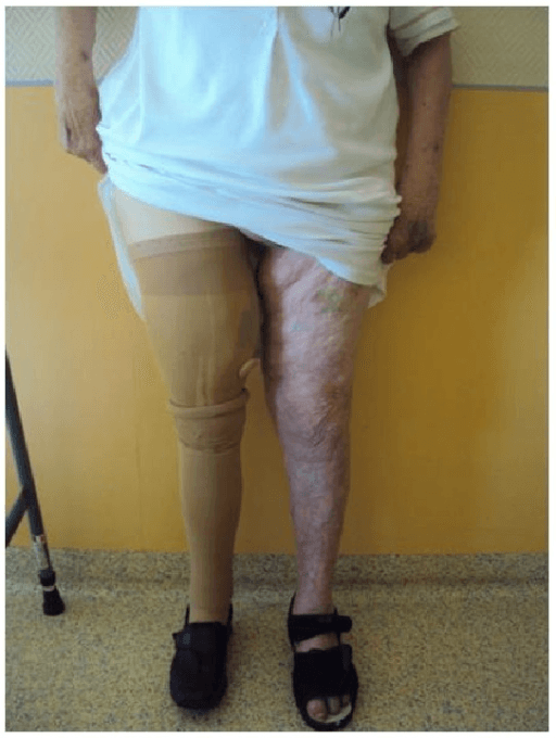 Transfemoral amputation stump in standing patient wearing compression dressing