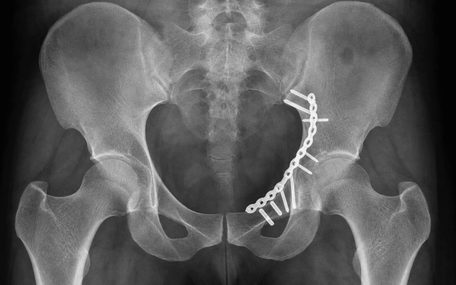 Anterior column acetabular fixation