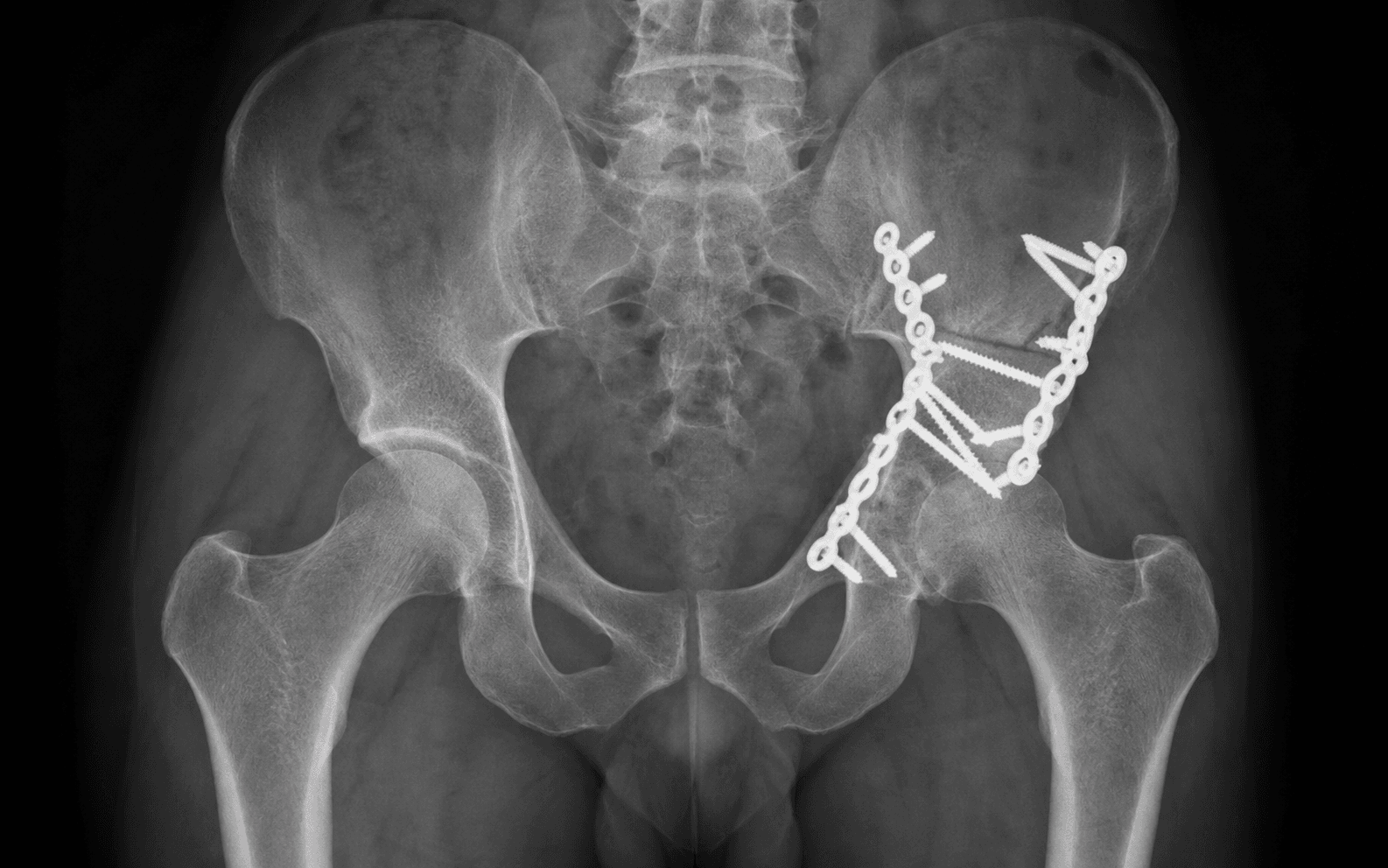 Both-column acetabular fixation