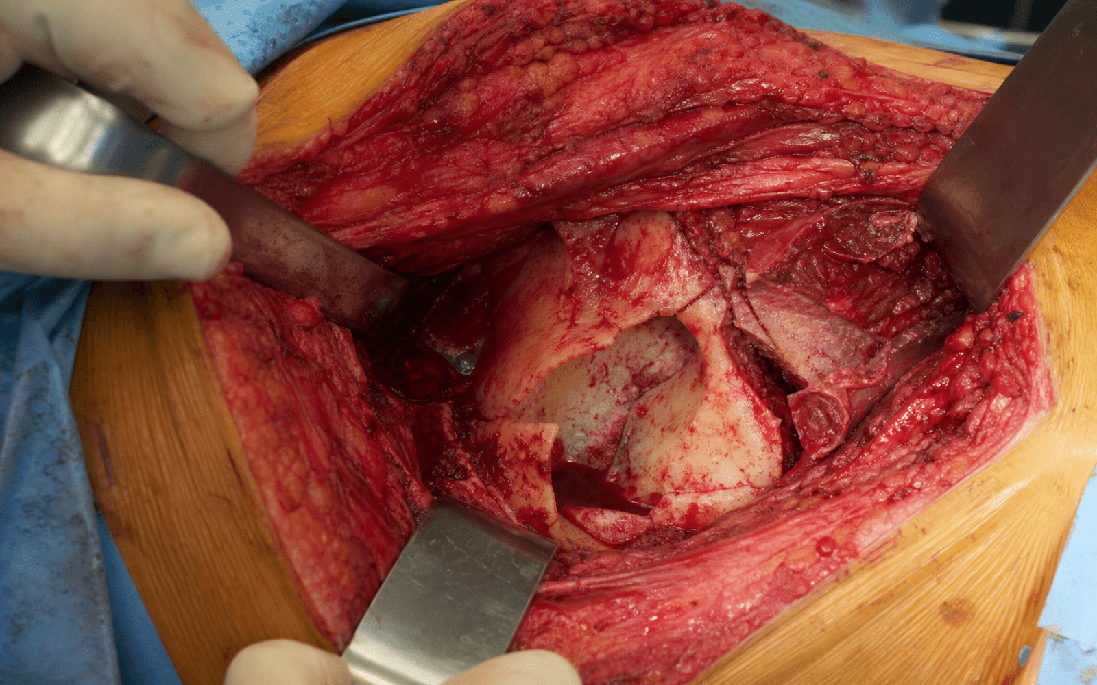 Acetabular surgical exposure