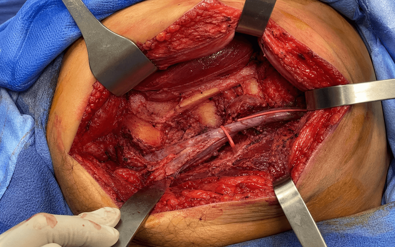 Ilioinguinal approach exposure