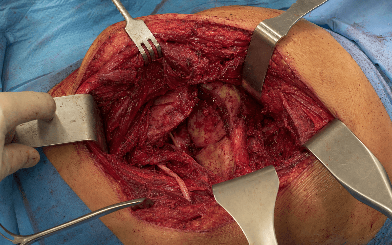 Intra-operative Kocher-Langenbeck exposure of the acetabulum