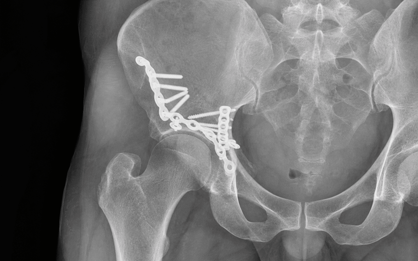 Posterior column and wall fixation