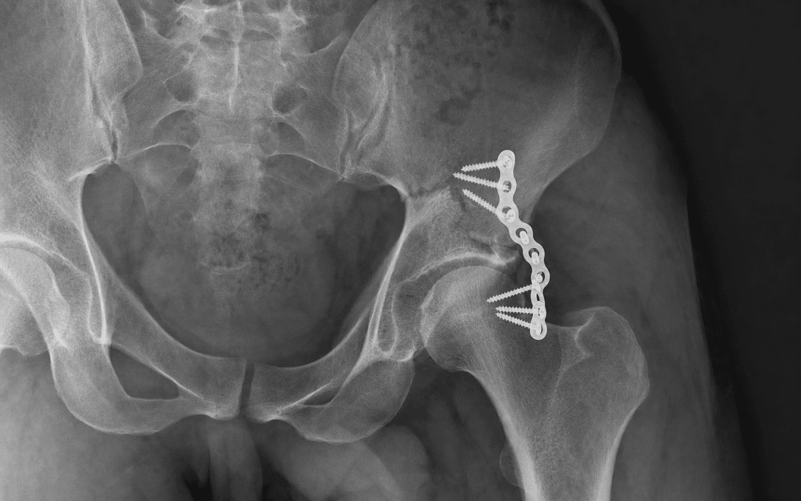 Posterior wall buttress plating