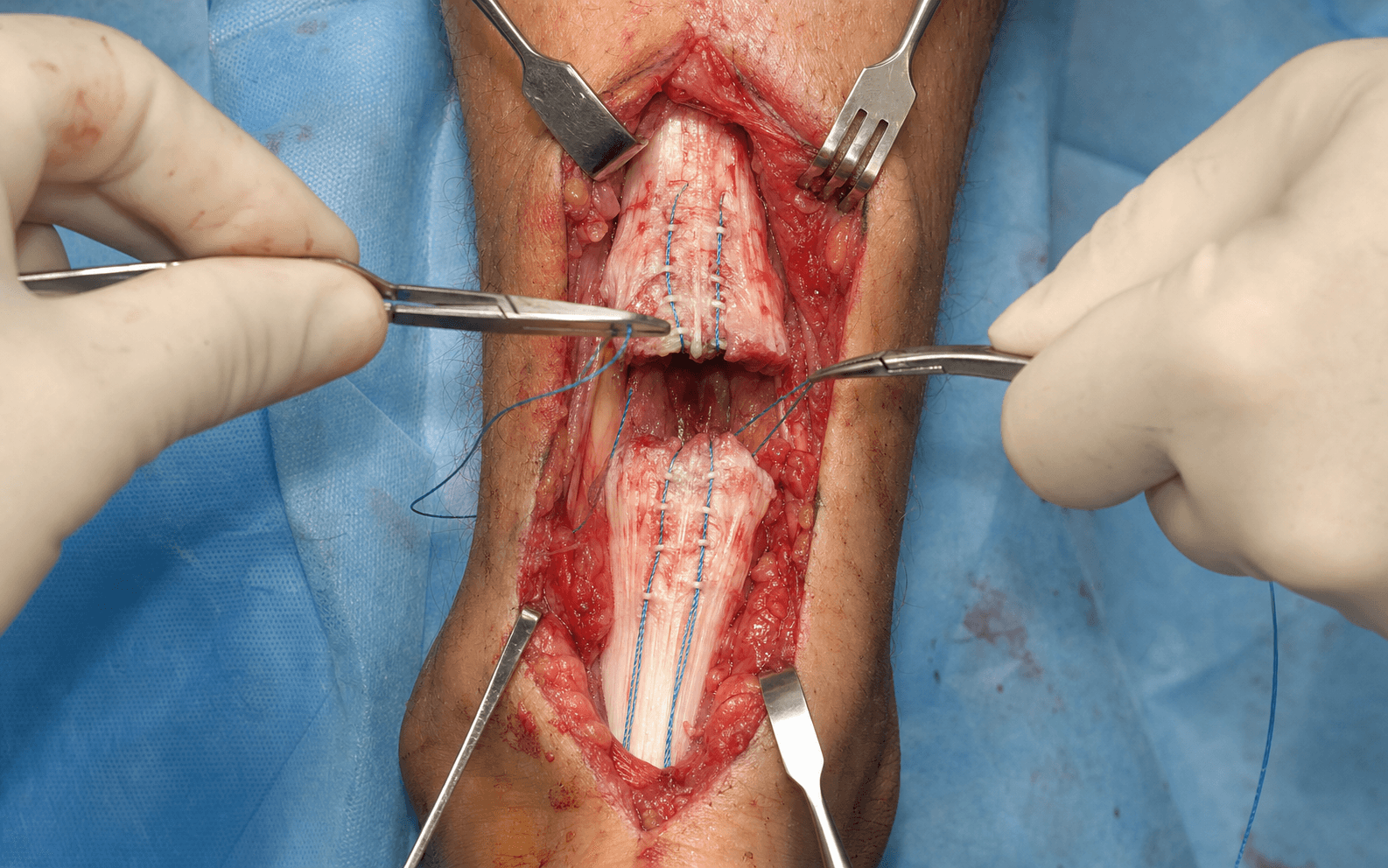 Open Achilles tendon repair