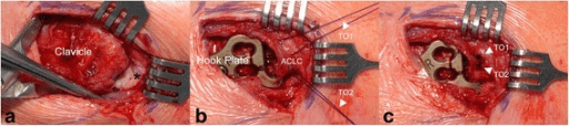Three-panel intraoperative sequence showing ACJ reconstruction with hook plate and coracoclavicular fixation