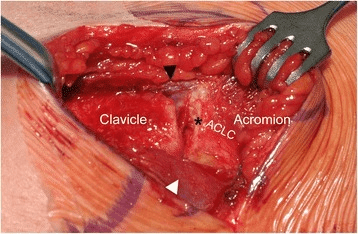 Intraoperative view showing clavicle and acromion with torn acromioclavicular ligament complex arrow