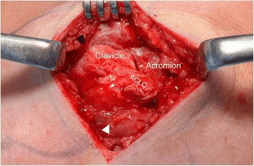 Intraoperative view showing clavicle and acromion with acromioclavicular joint gap marked by white arrowhead
